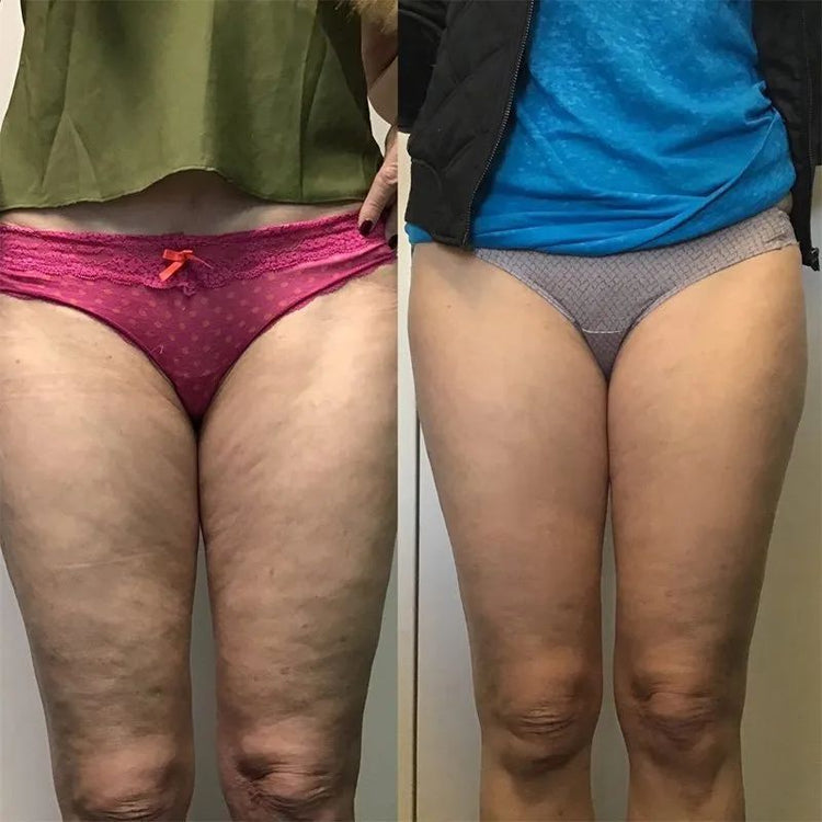 Antes y después de piernas - Transformación 1