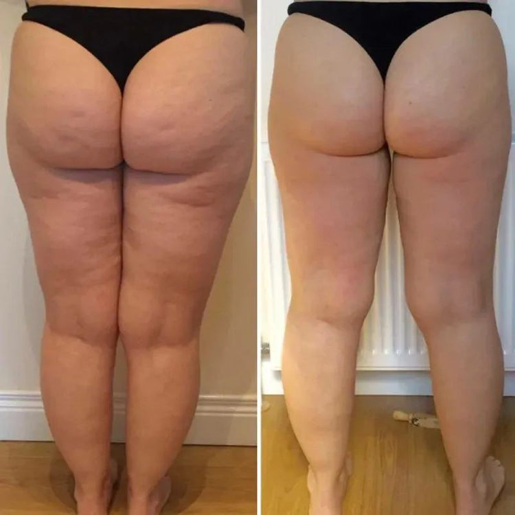 Antes y después de glúteos - Transformación 2
