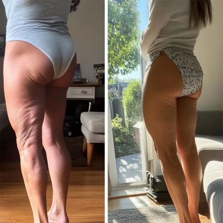 Antes y después celulitis en glúteos - Transformación 4